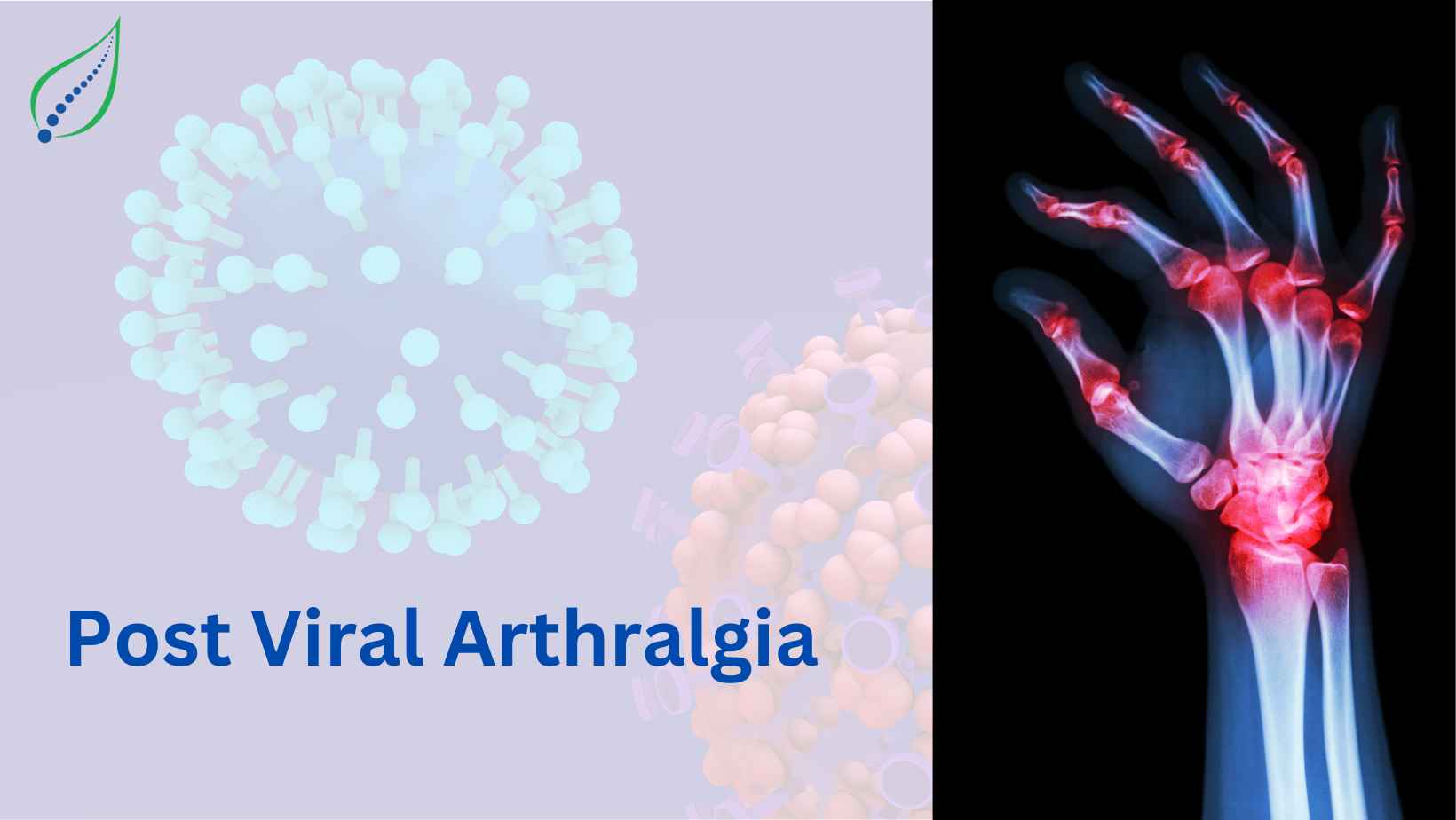 Post Viral Arthralgia